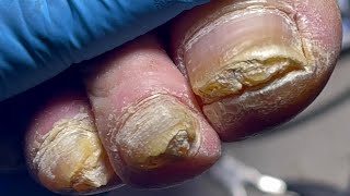 Thick nails every toenail infected with onychomycosis【Pedicure Master Lin Jun】 [upl. by Enegue995]