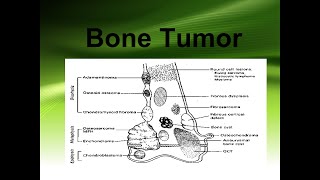 Bone tumors part I [upl. by Cirri90]