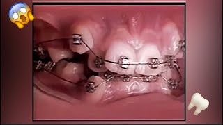 2 Years Of Braces In 20 Seconds Braces Timelapse Shorts [upl. by Aneryc]