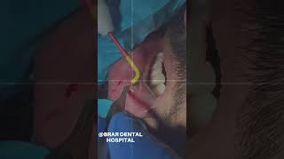 Mucocele removal youtube dentistnearby shortvideos dentalclinic dentist trending viral [upl. by Adnauqal]