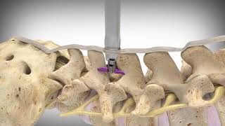 Vertiflex Procedure at Michigan Pain Consultants [upl. by Almeida]