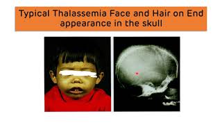 Beta Thalassemia and Alpha Thalassemia  Types Diagnosis and Treatment  Thalassemia Major amp Minor [upl. by Dnalyram]