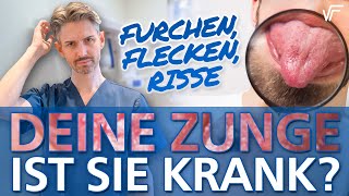 Risse und Furchen in der Zunge Flecken auf der Zunge Ist meine Zunge krank [upl. by Airetnohs]