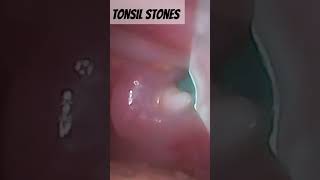 Tonsil stones tonsils tonsilstones tonsilolitos nasty gross [upl. by Temirf]