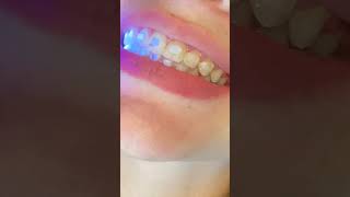 Girl Uses Spoon To Take Own Braces Off 😬🦷🥄 Orthodontist Reacts [upl. by Eciralc]