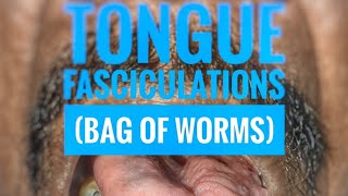 Tongue fasciculations quotBag of wormsquot  mbbs medicine neurology [upl. by Estel]