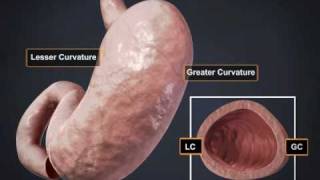 Laparoscopic Greater Curvature Plication LGCP Weight Loss Procedure [upl. by Lennon]