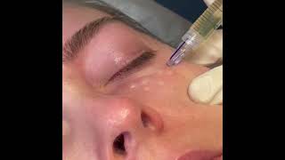 MicronJetTM in Action Intradermal Delivery of Aesthetic Product to the Preorbital Under Eye Area [upl. by Cirilla]