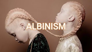 albinism [upl. by Ainaznat]