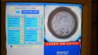 Myoring implantation after Intralase pocket creation [upl. by Aicemaj918]