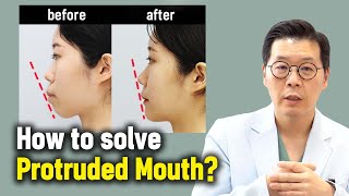 ENJP How to solve Protruded Mouth l Korean Protruded Mouth surgery case review [upl. by Evetta]