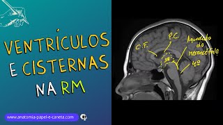 Ventrículos e Cisternas Cerebrais por RM [upl. by Thacher244]