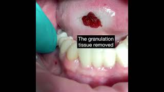 Serrated Curette helps Remove Granulation Tissue from Dental Infections [upl. by Nyvrem818]