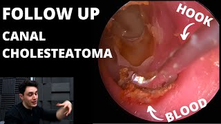 FOLLOW UP Canal Cholesteatoma Patient Is Back [upl. by Eglantine]