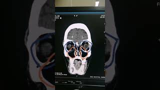 Farhr Syndrome  Syndrome of Head  Calcific densities seen on CT  Dr Green Side  Medical Imaging [upl. by Nostrebor]