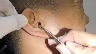 One Hard Earwax Removed form Mans Ear [upl. by Ambrosia944]