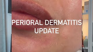 Morning Skincare  Perioral Dermatitis Update [upl. by Farwell820]