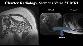 Shoulder MRI Lipoma [upl. by Lona]