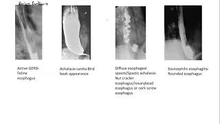 Barium studies  Esophagus  Achalasia Cardia  Bird beak appearance  High yield Medcampus [upl. by Aryhs677]