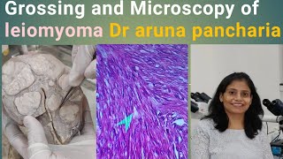 Leiomyoma fibroid grossmicroscopypathology histopathology mbbs uterusproblemeducational [upl. by Eusebio427]