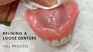 Relining a Loose Denture  Full Process [upl. by Boarer]