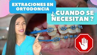 Extraciones en ortodonciabrackets 7 Razones para hacerlas [upl. by Arracat277]