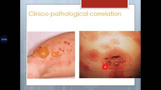 Basic Dermatopathology 14 Algorithm for inflammatory dermatopathology [upl. by Hurleigh297]