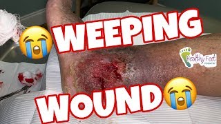 Weeping Wound [upl. by Alamaj364]