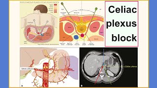 celiac plexus block [upl. by Carleen]