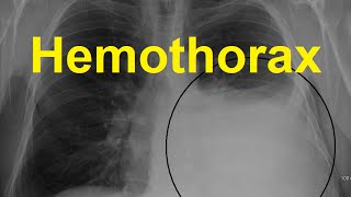 Hemothorax Symptoms Causes and Treatment [upl. by Mond]