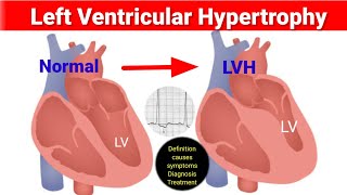 LVH Left ventricle Hypertrophy causesDiagnosistreatment How to regress LVH LVH क्या होता है [upl. by Etteinotna]