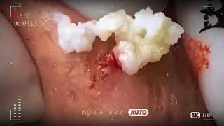 blackhead removal satisfying video [upl. by Eibor]