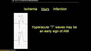 1215 Lead ECG Ischemia Injury and Infarction [upl. by Nunci575]