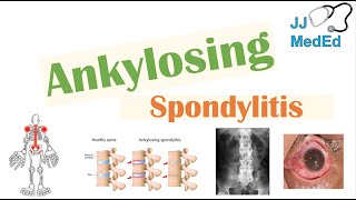 Ankylosing Spondylitis  HLAB27 Pathophysiology Signs amp Symptoms Diagnosis Treatment [upl. by Demeyer]