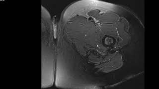 MRI HIP TUTORIAL [upl. by Silvestro701]