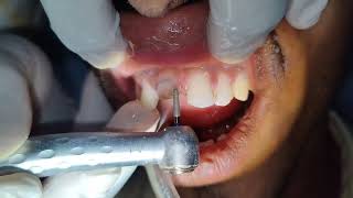 Non Vital Toot Treatment Part 2  Easy Ceramic Crown Preparation  PFM Crown Preparation [upl. by Conlin]