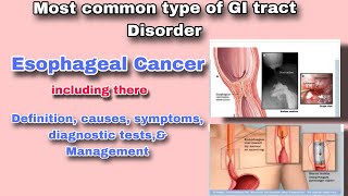 Understanding Esophageal Cancer  Symptoms Diagnosis and Treatment [upl. by Rudolfo]