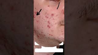 The Ultimate Guide to Treating Papulopustular Acne [upl. by Esnofla445]