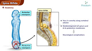 Spina Bifida  Orthopedics Lecture [upl. by Nivak]