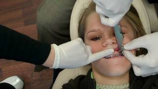 See TAD Placement at Wilson Orthodontics Tel 7705360882 [upl. by Dj]