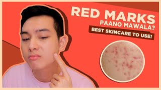 How to FADE RED MARKS FASTER with SKINCARE  DOs amp DONTs  Jan Angelo [upl. by Anu]