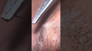 Ingrown hair plucking ASMR lower stomach tweezing [upl. by Marte]