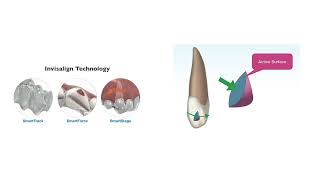 Lateral Incisor Attachment Design in invisalign｜【Chris Chang Ortho】CC782 [upl. by Ahselaf]