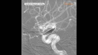 Cerebral Aneurysm Coiling in Innvolution Cath Lab [upl. by Raffaello]