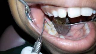 Indication tooth preparation and application of Pit and Fissue Sealants [upl. by Jeremy821]