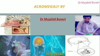 Achieve Mastery In Acromegaly Within 10 Minutes  Dr M B [upl. by Yetak]