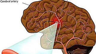 Intracerebral HemorrhageICHEtiology PathophysiologyClinical Features Diagnostic Treatment [upl. by Nmutua]