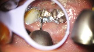 Indepartare ablatie lucrare dentara fara durere Dental crown removal Painless [upl. by Nwad954]