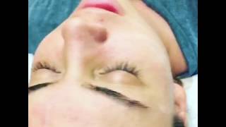 30 salicylic chemical peel at Skin at Alon Aesthetics Plastic Surgery [upl. by Scotney]