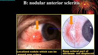 Sclera Lect By Dr Abdul Basir Safi 1 [upl. by Yantruoc]